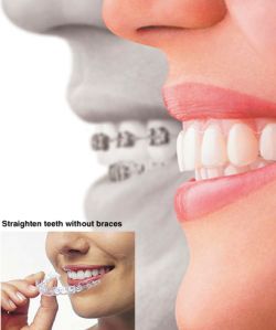 inline-invisalign